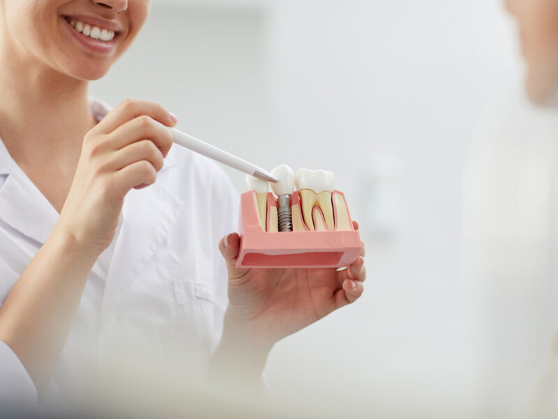 implantes dentales