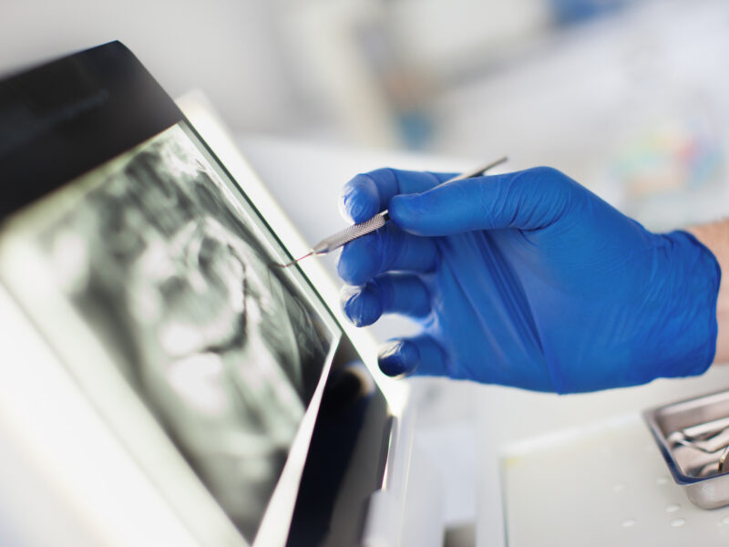 desgaste dental avanzado