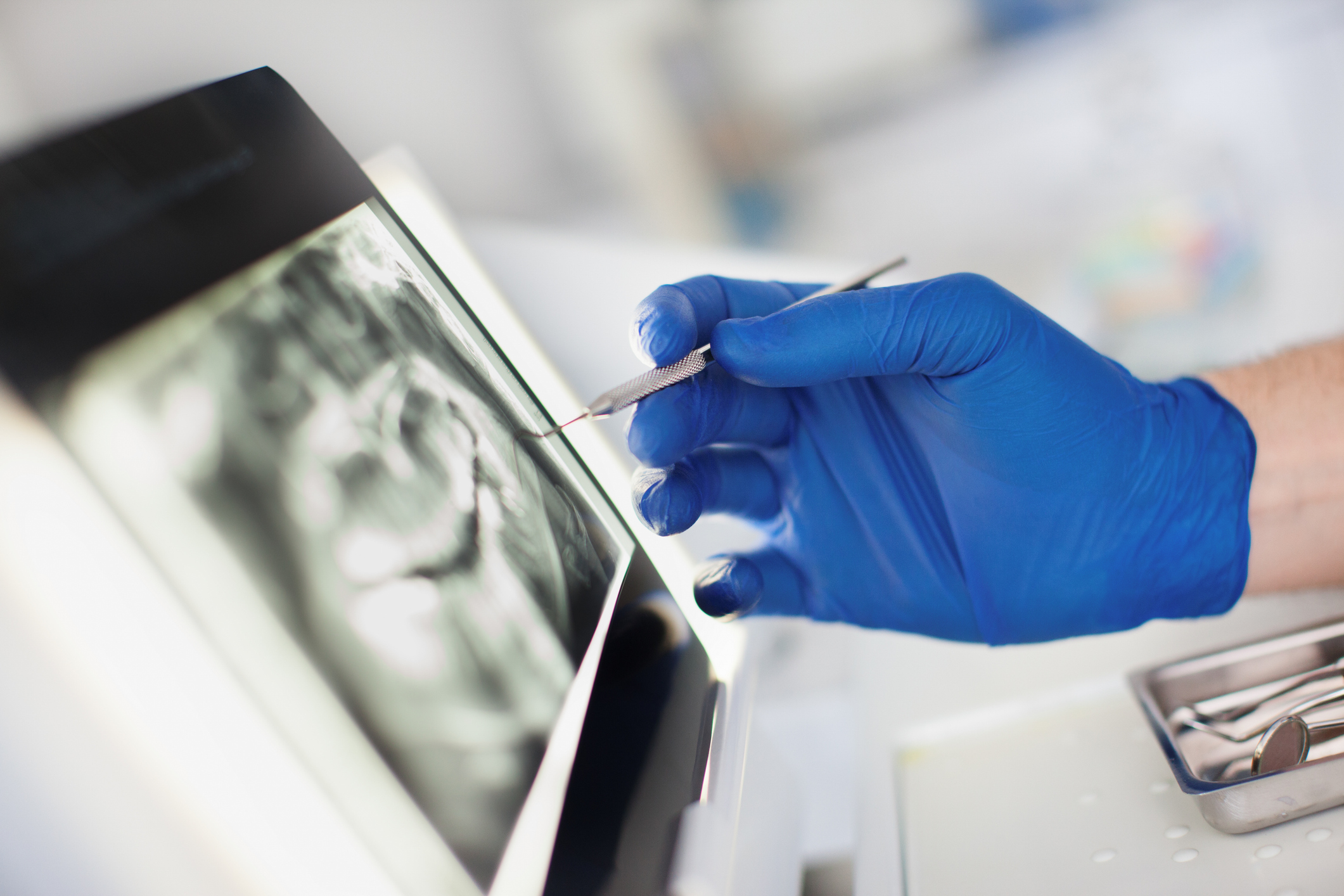 desgaste dental avanzado