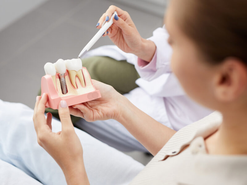 implantes dentales